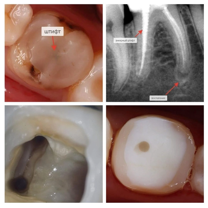 Перелечивание зуба: результат через 1,5 года. 