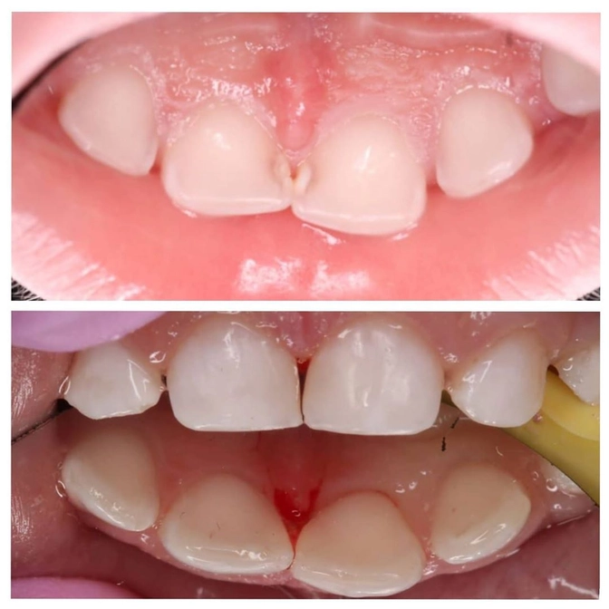 Лечение кариеса у ребёнка 