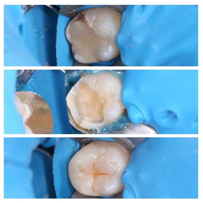 Зачем менять старые пломбы? 