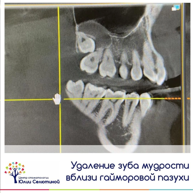 Удаление зубов мудрости вблизи гайморовой пазухи: в чем сложность? 