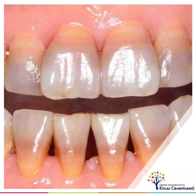 Что такое "тетрациклиновые зубы"?