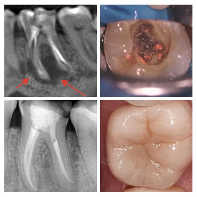 Перелечивание безнадежного зуба 