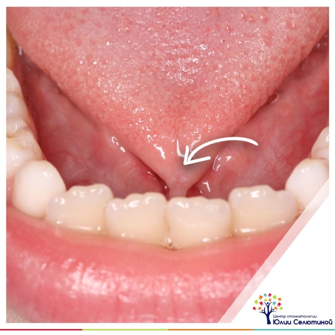 Пластика уздечки языка: когда и как это все делается?