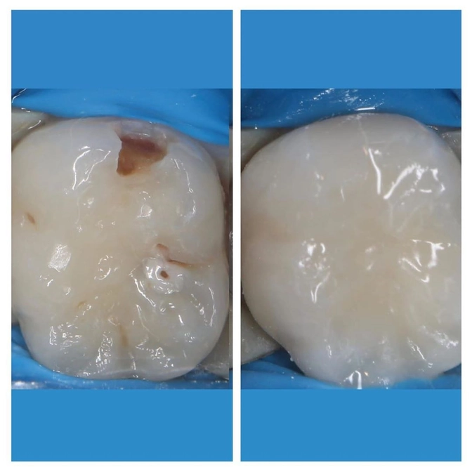 Кариес молочных зубов 