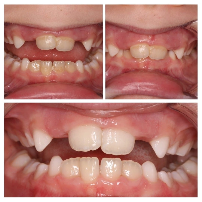 Какие проблемы мы можем выявить в сменном прикусе 