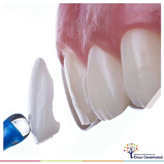 Все о винирах. 