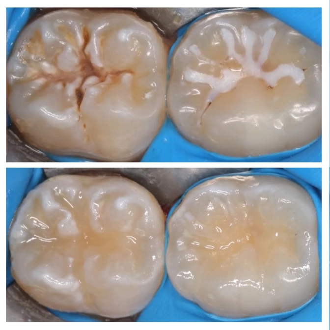 Профилактика кариеса: герметизация фиссур