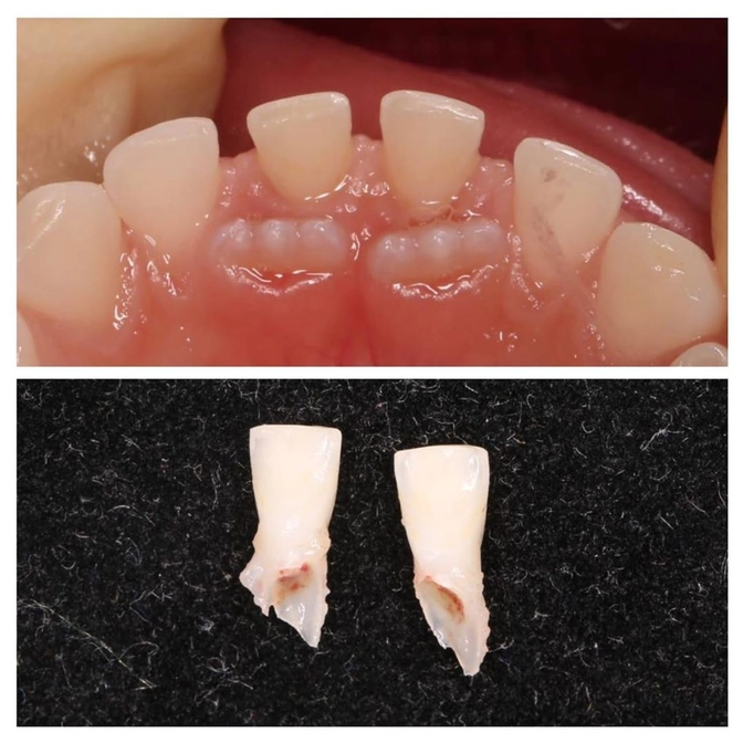 Что делать, если постоянный зуб прорезался, а молочный еще не выпал?