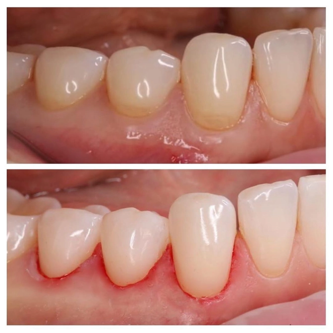 Абфракционный дефект: что это и что делать? 