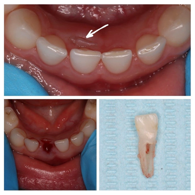 Что делать, если молочный зуб не торопится выпадать?