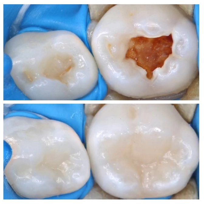 Лечение без наркоза в 2.7 лет!