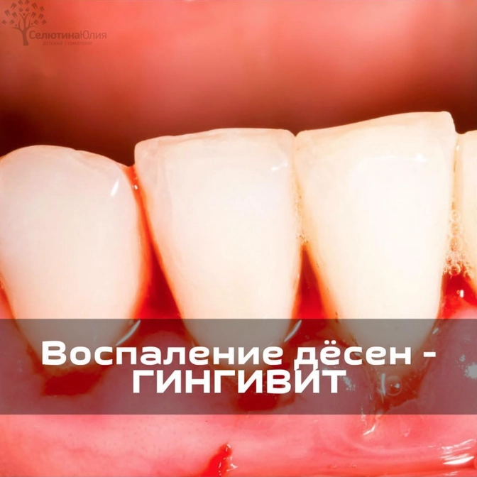 Воспаление десен