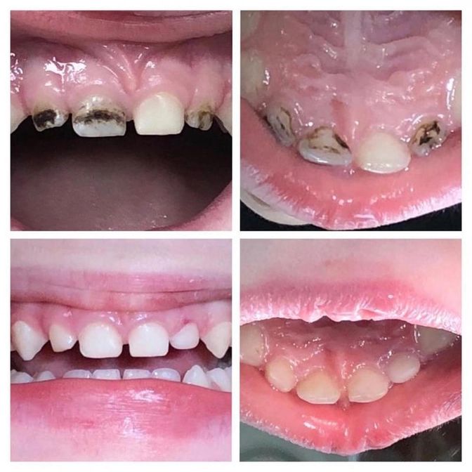 Серебрение молочных зубов.