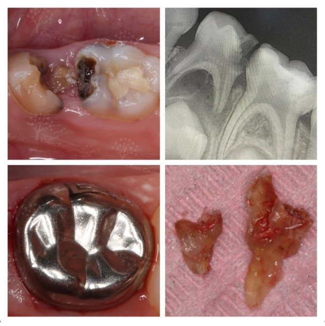 Лечение и удаление зубов у ребенка 