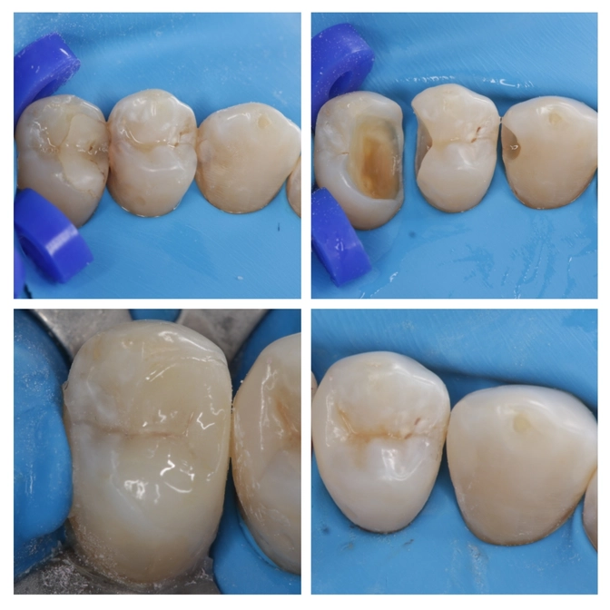 Клинический случай: лечение контактного кариеса 