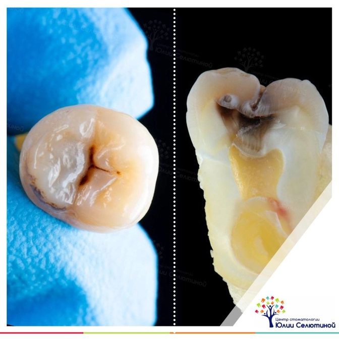 Как обманчив может быть кариес!