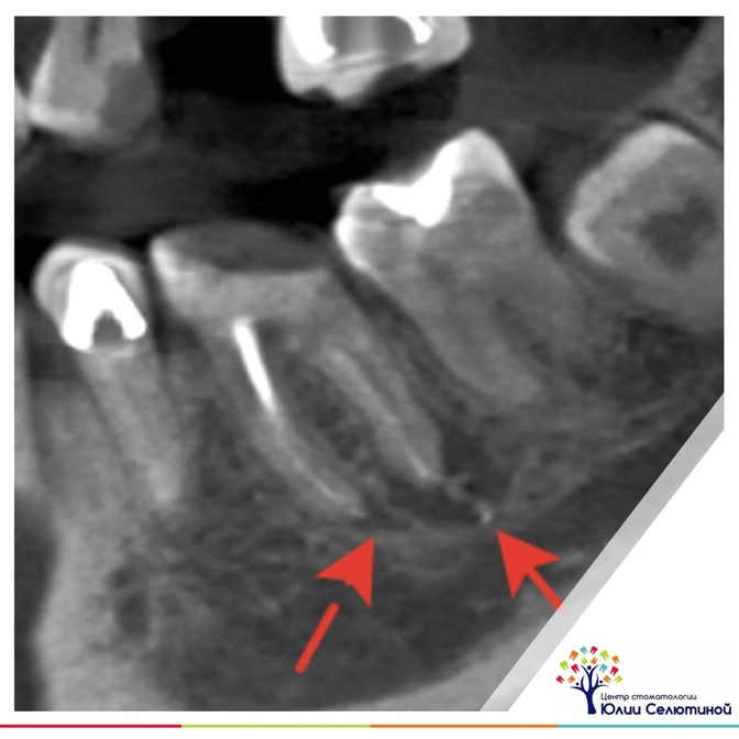 Киста: почему она возникает? 
