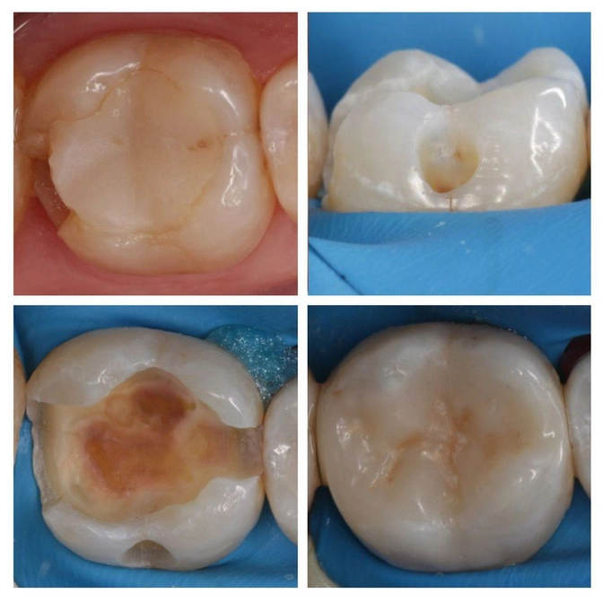 Клинический случай: вторичный кариес