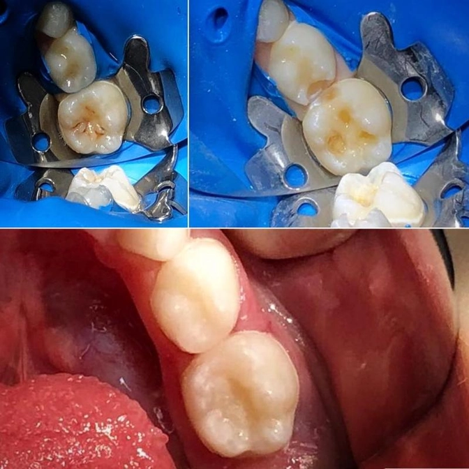 Кариес между зубами.
