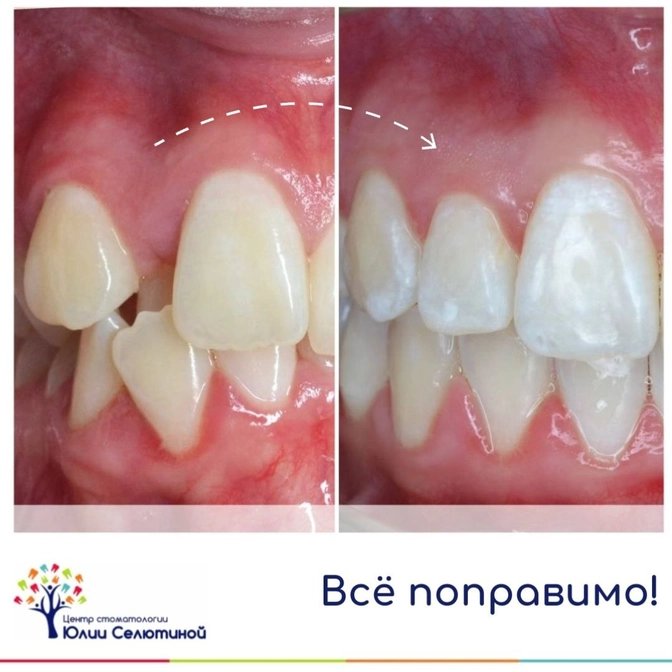 Эстетика центральных зубов
