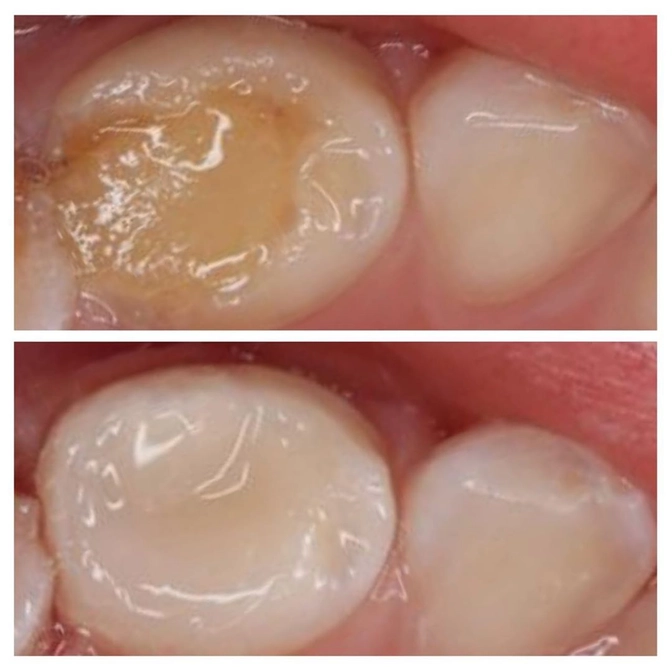 Замена старых пломб на молочных зубах.
