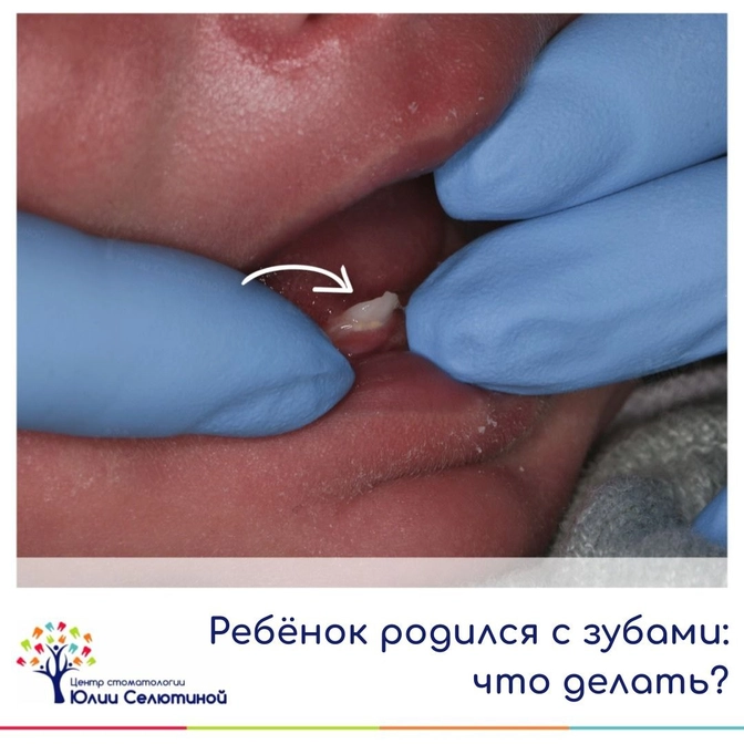 Ребёнок родился с зубами: что делать?