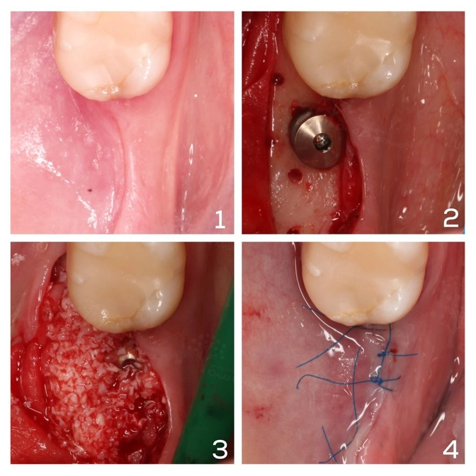 Что делать, если костной ткани не достаточно для импланта?