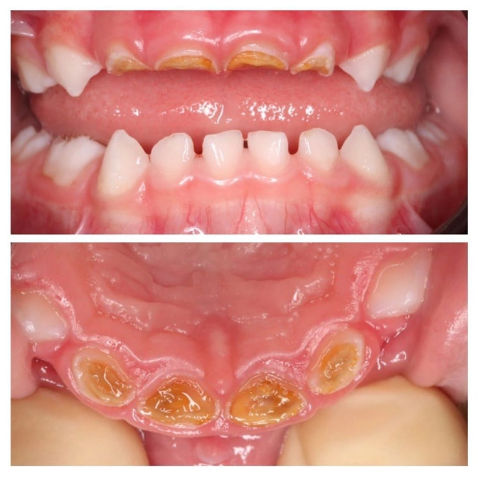 Стремительность кариеса раннего детского возраста.