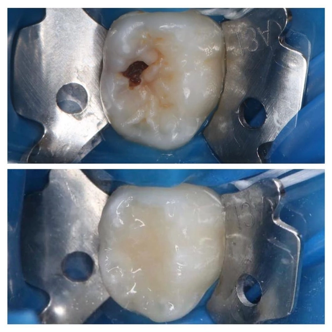 Как защитить жевательные зубки? 