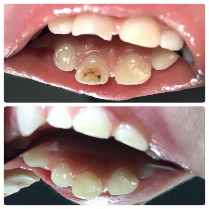 Кариес на небной поверхности