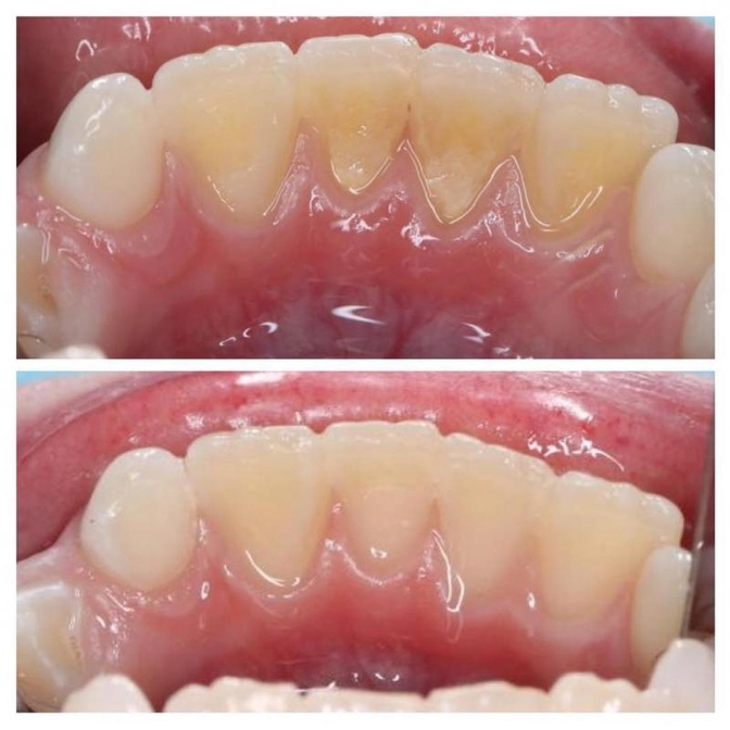 Бывает ли у детей зубной камень?