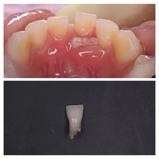 Что делать, если молочный зуб помешал постоянному прорезаться ровно?