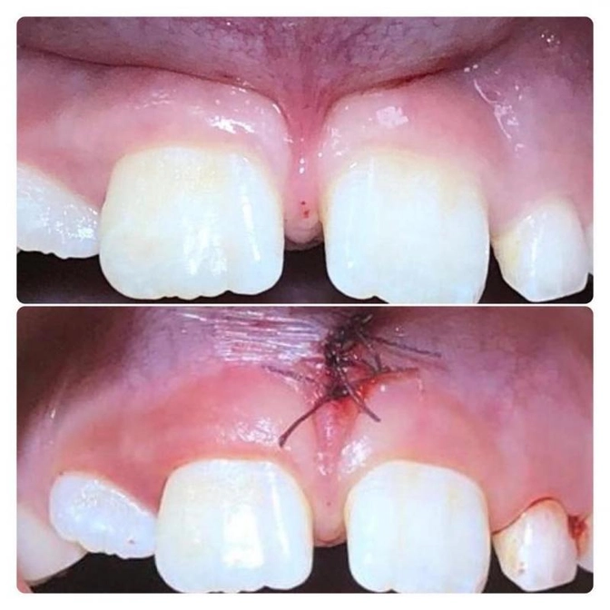 Пластика уздечки верхней губы.