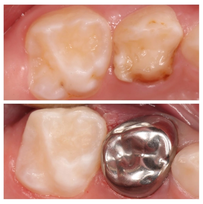 Лечение зубов ребенка без наркоза! 