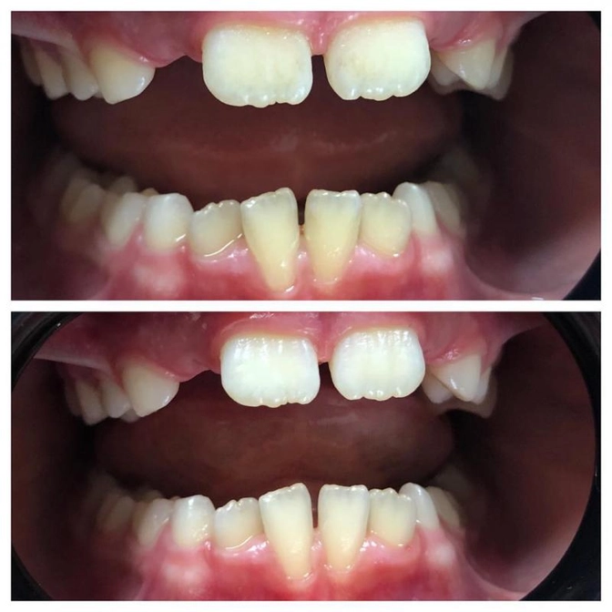 Рецессия десны.