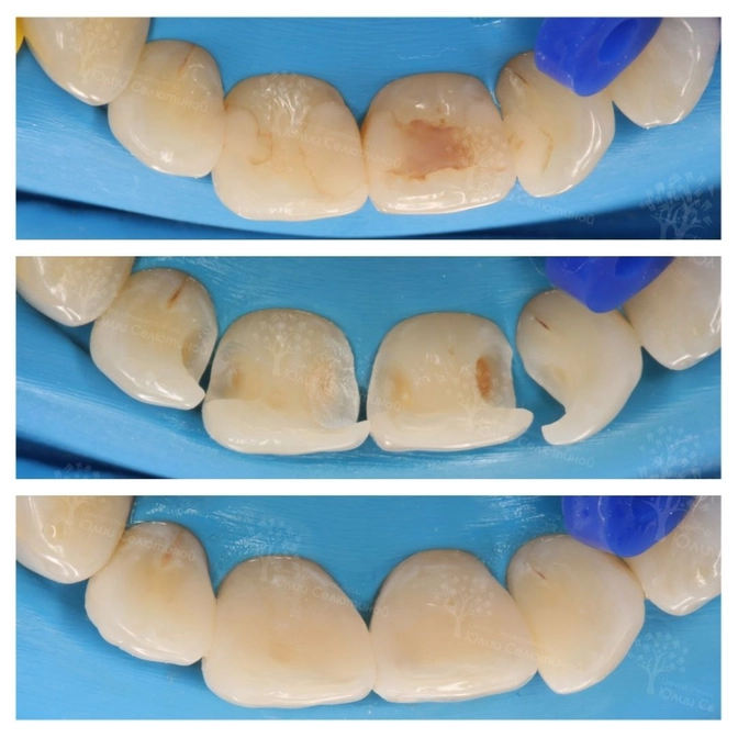 В чём отличие реставрации от пломбы? 