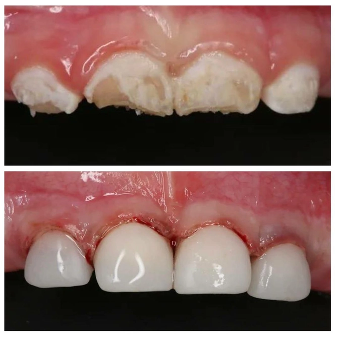 Лечение молочных зубов под наркозом. 