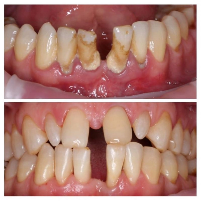 Профессиональная гигиена полости рта - первый этап лечения.