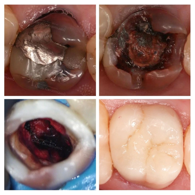 Перелечивание очень сложного зуба 