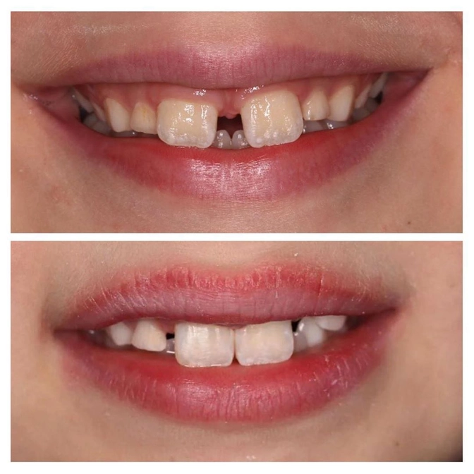 Ортодонтическое лечение в сменном прикусе.