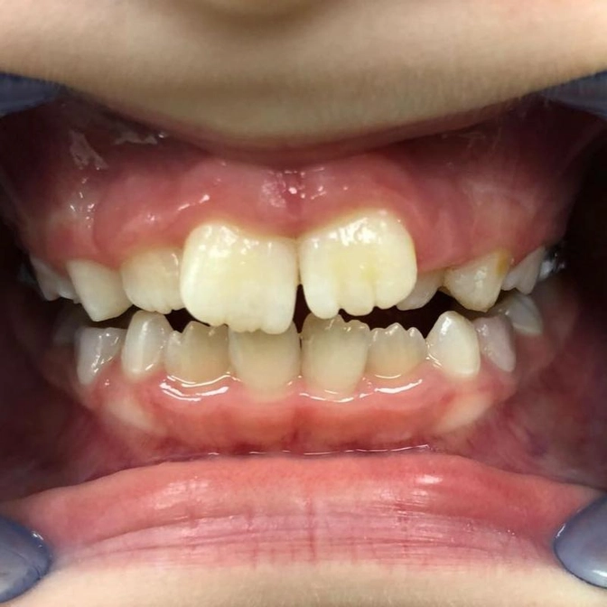 Аппарат Haas: показания к лечению.