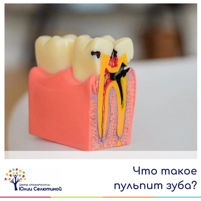 Что такое пульпит зуба?