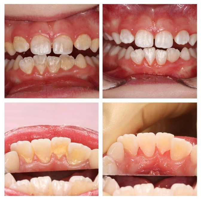 Зубной камень у детей 