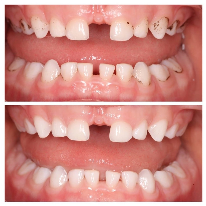 Профессиональная гигиена полости рта у ребенка 