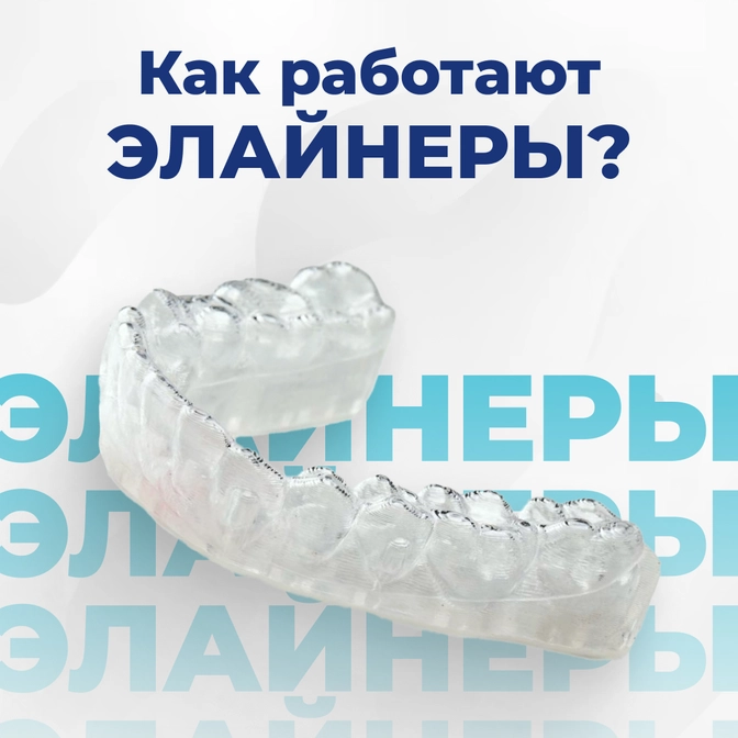 Как работают элайнеры?