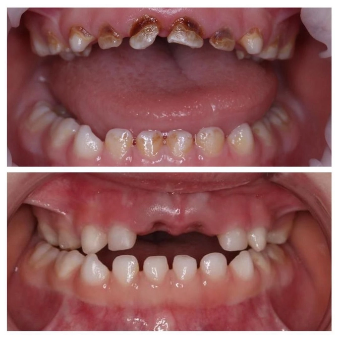 Лечение молочных зубов под наркозом.