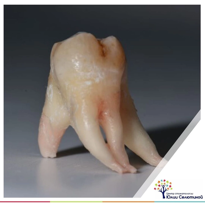 Удаление зуба "мудрости": в чем может быть сложность?