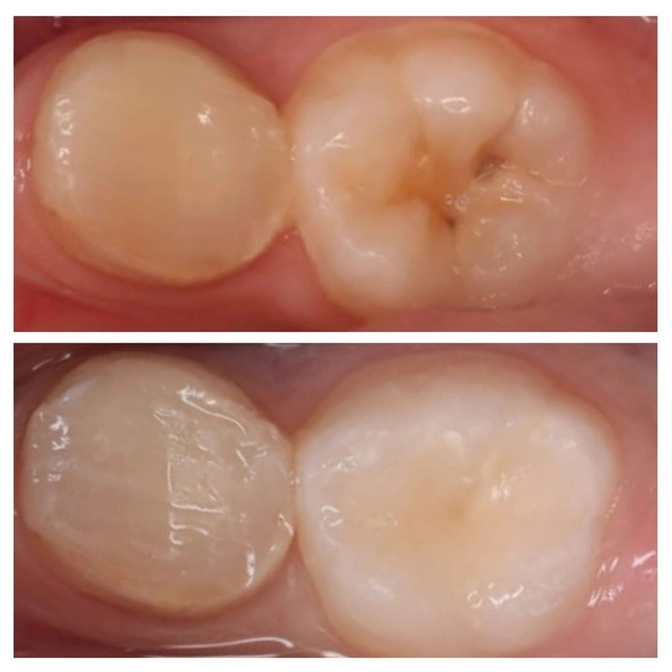 Лечение постоянного зуба у ребёнка