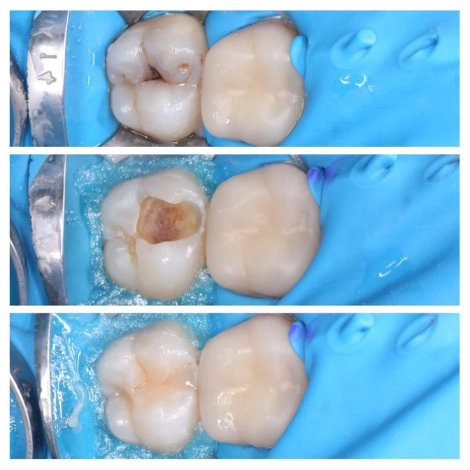Кариес или пульпит?