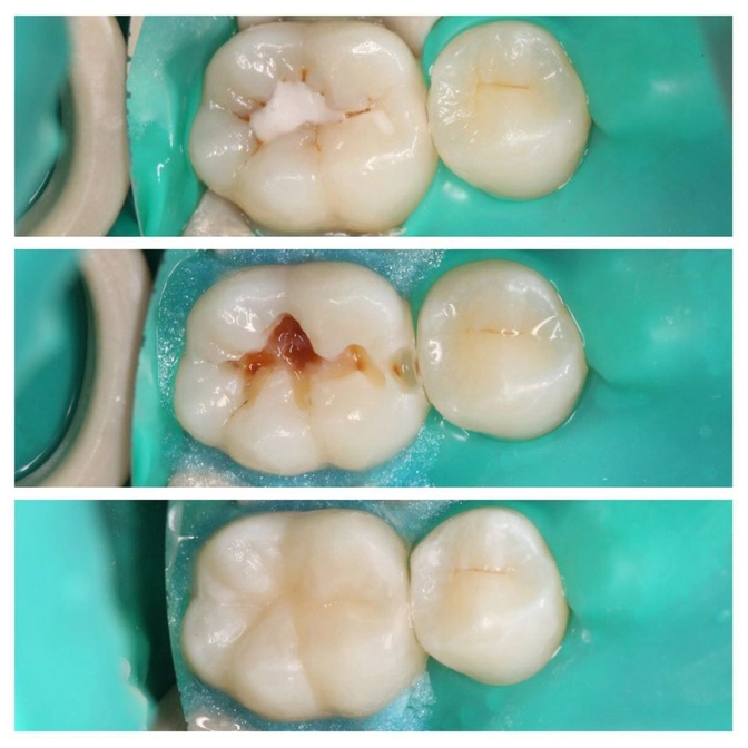 Лечение вторичного кариеса 